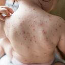 El 95 % de las personas pueden enfermarse de varicela a lo largo de su vida.