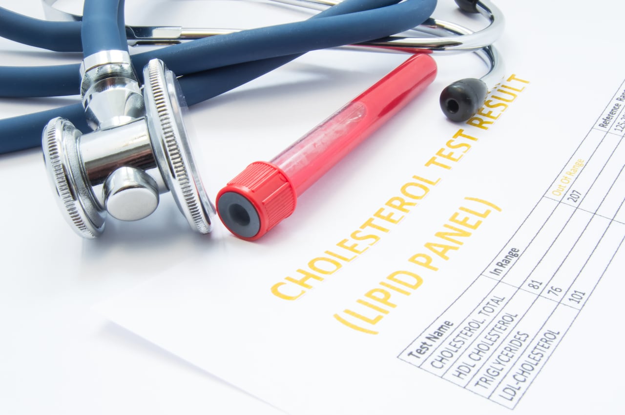 El resultado del análisis de la prueba de colesterol (panel de lípidos), los tubos de ensayo con sangre y un estetoscopio médico se encuentran sobre la mesa. Concepto de diagnóstico de aterosclerosis en pacientes con colesterol alto en análisis de sangre