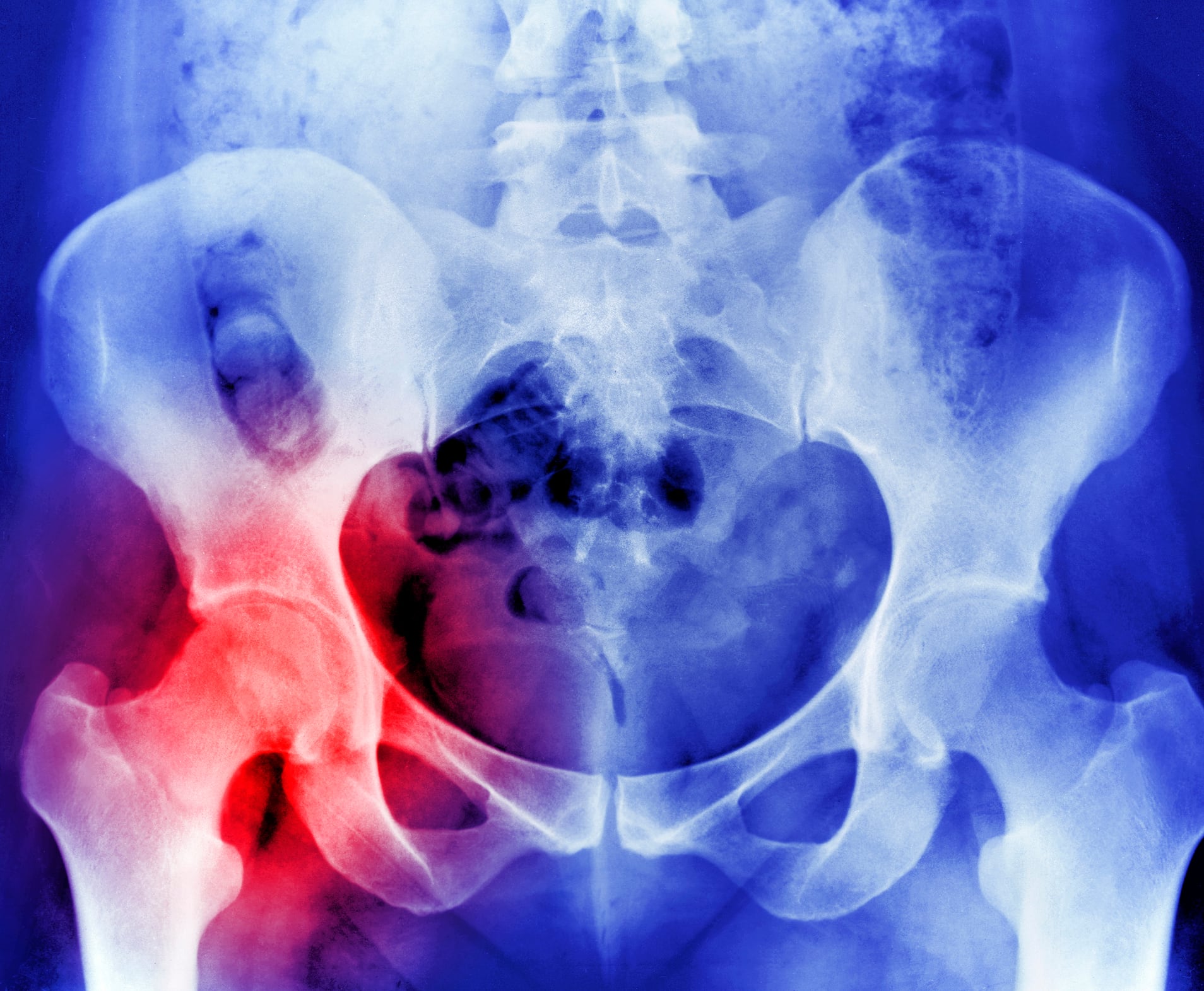X-RAY SHOWING OSTEOPOROSIS HIP REPLACEMENT