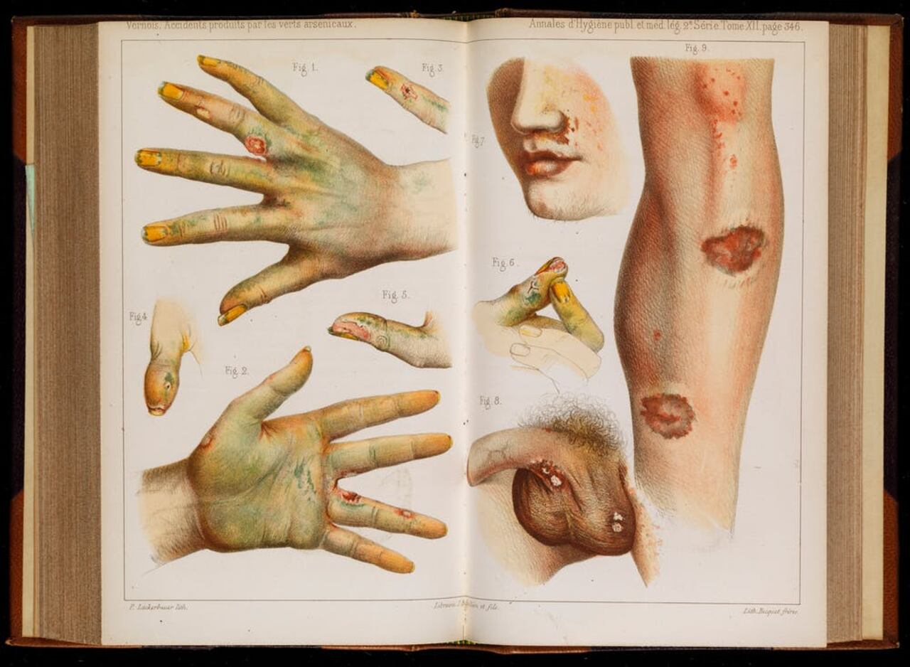 Accidentes provocados por el uso de arsénico verde, 1859. © Wellcome Collection, CC BY-SA