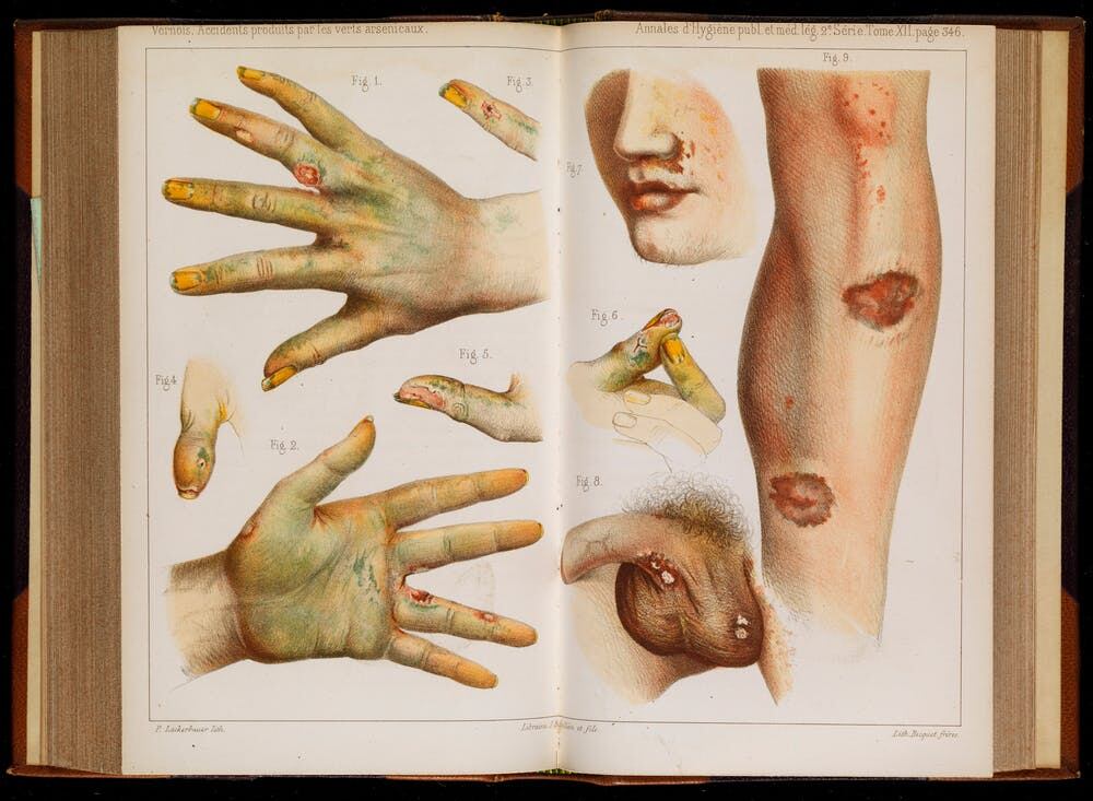 Accidentes provocados por el uso de arsénico verde, 1859. © Wellcome Collection, CC BY-SA