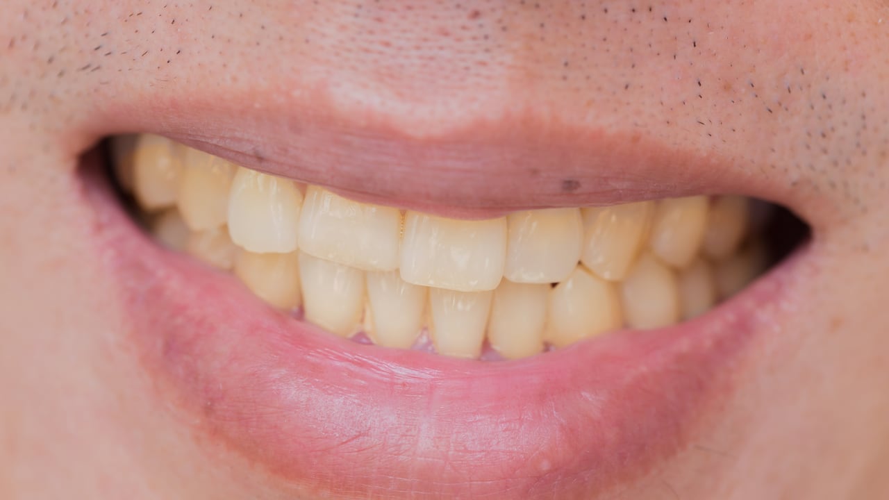 Placa dental: las 10 formas para eliminarla efectivamente desde casa