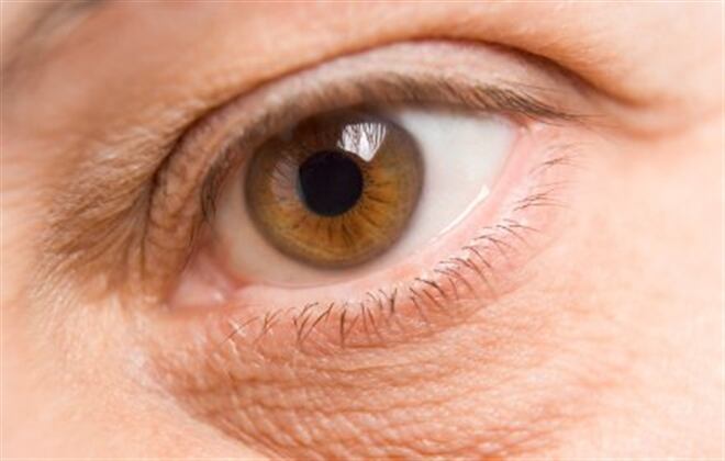 Remedios caseros contra las ojeras, foto: Thinkstock