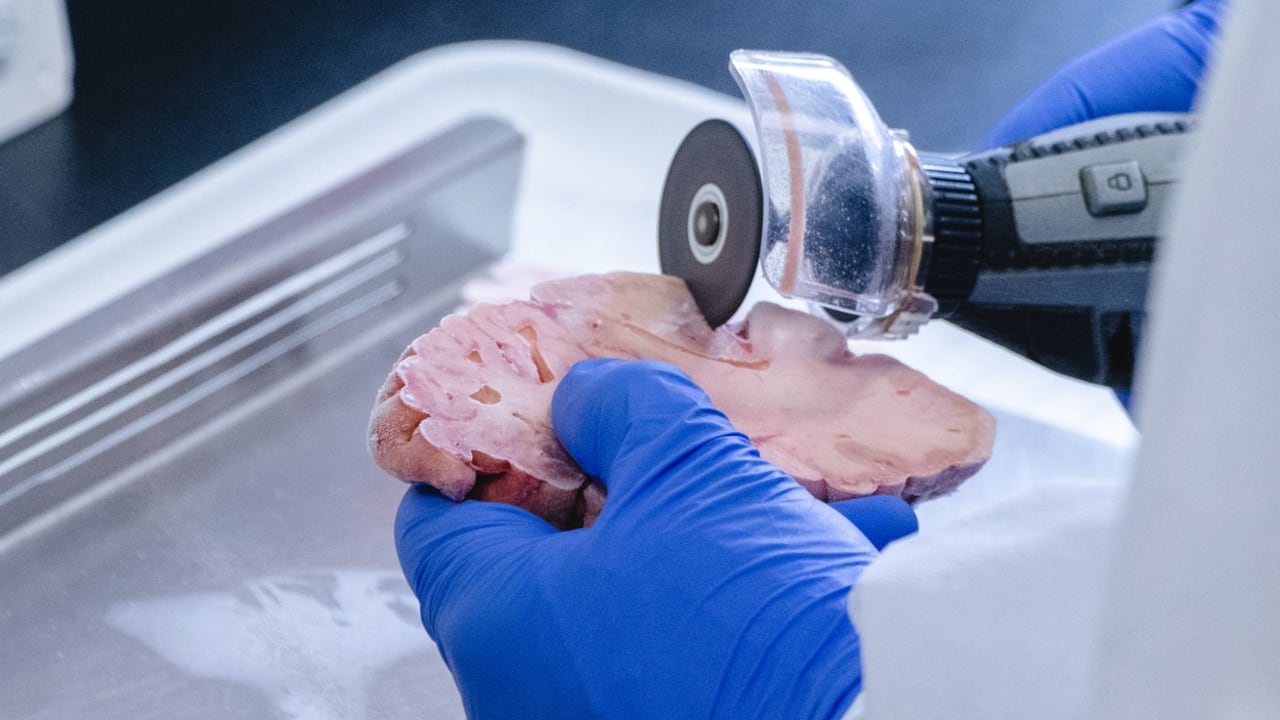 El Banco de Cerebros del Grupo de Neurociencias de Antioquia fue clave en la investigación.