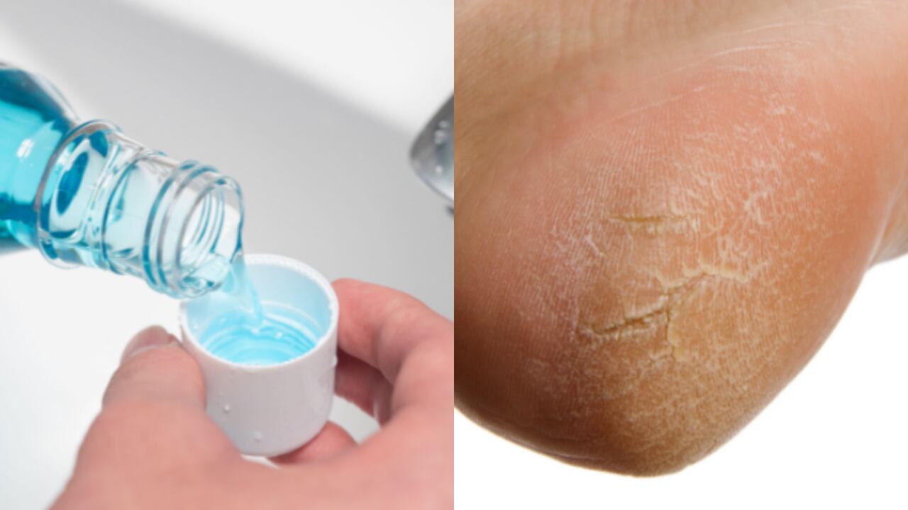 pies, enjuague bucal, callos, pies agrietados, dientes