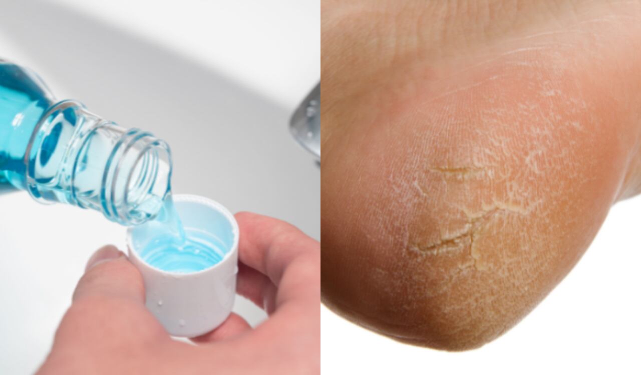 pies, enjuague bucal, callos, pies agrietados, dientes