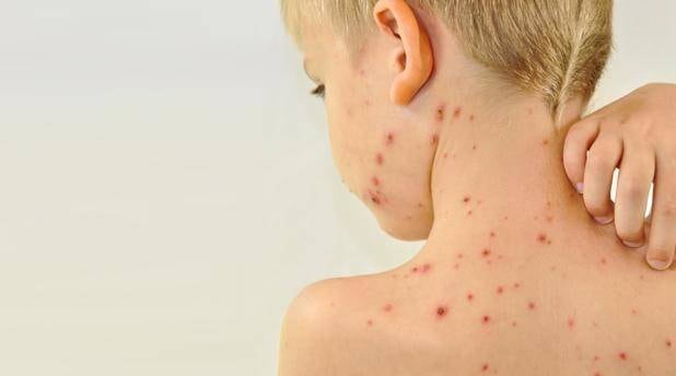 La enfermedad se manifiesta por una fiebre muy alta y luego un sarpullido. 