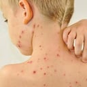 La enfermedad se manifiesta por una fiebre muy alta y luego un sarpullido.