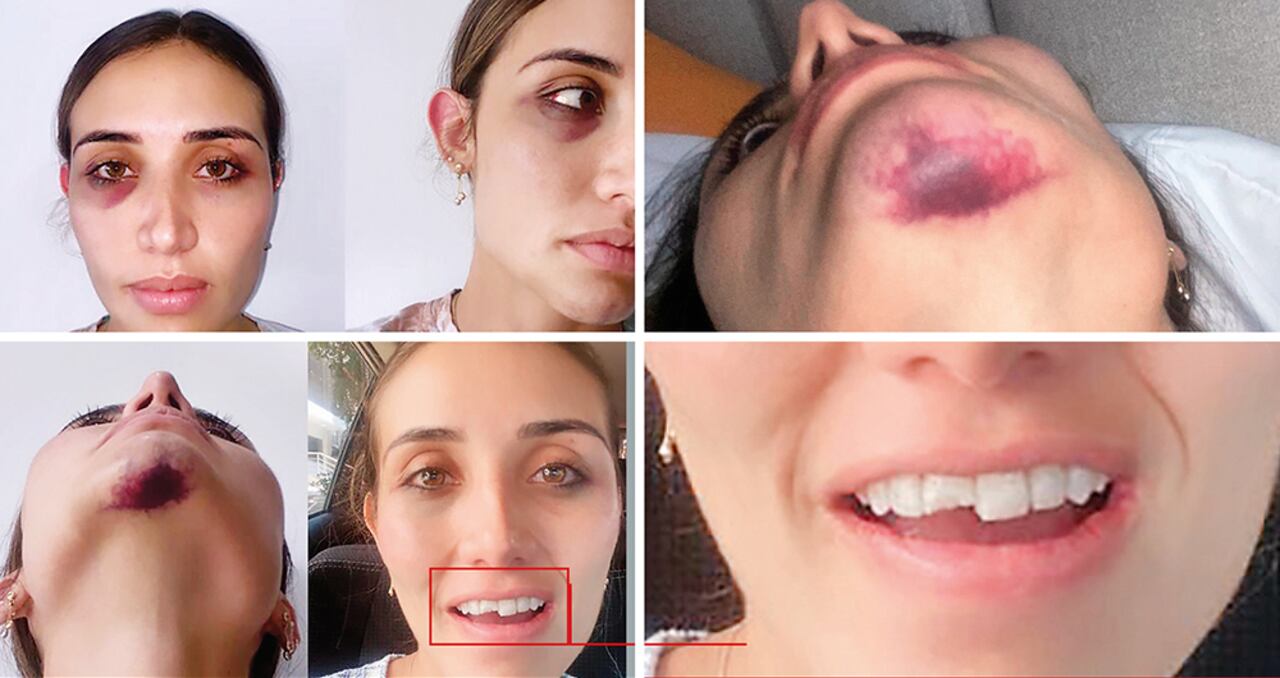 En las imágenes, ella muestra los hematomas en uno de sus ojos y en su barbilla. Se ven claramente varios dientes partidos.
