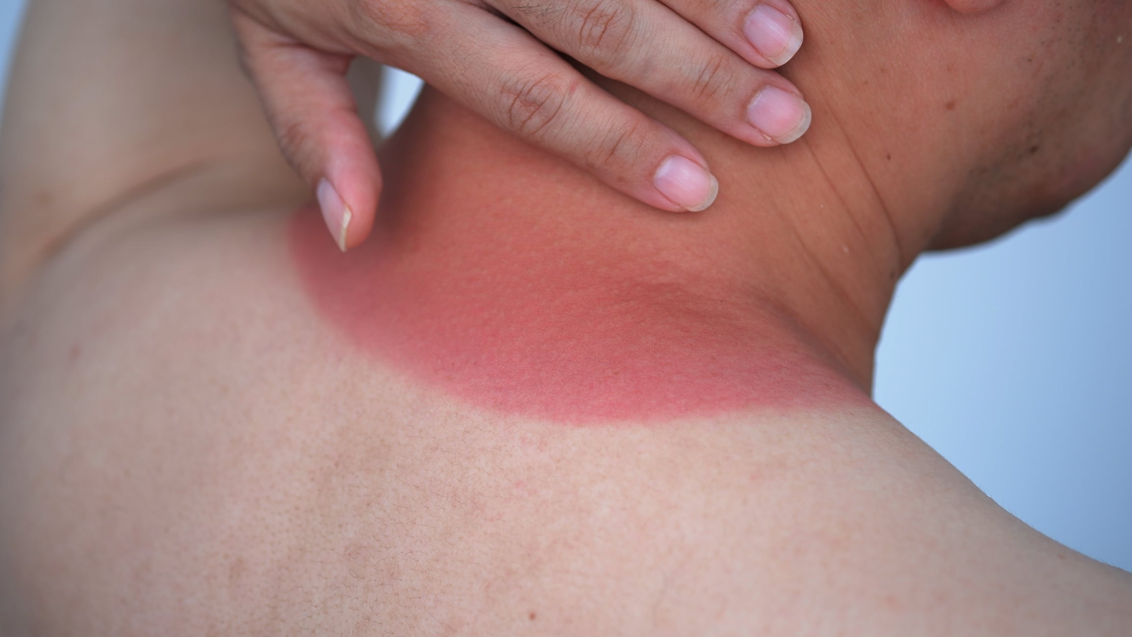 El ARN, descubierto como clave en las quemaduras solares, podría cambiar el enfoque de la ciencia sobre la radiación UV y su impacto en la piel.