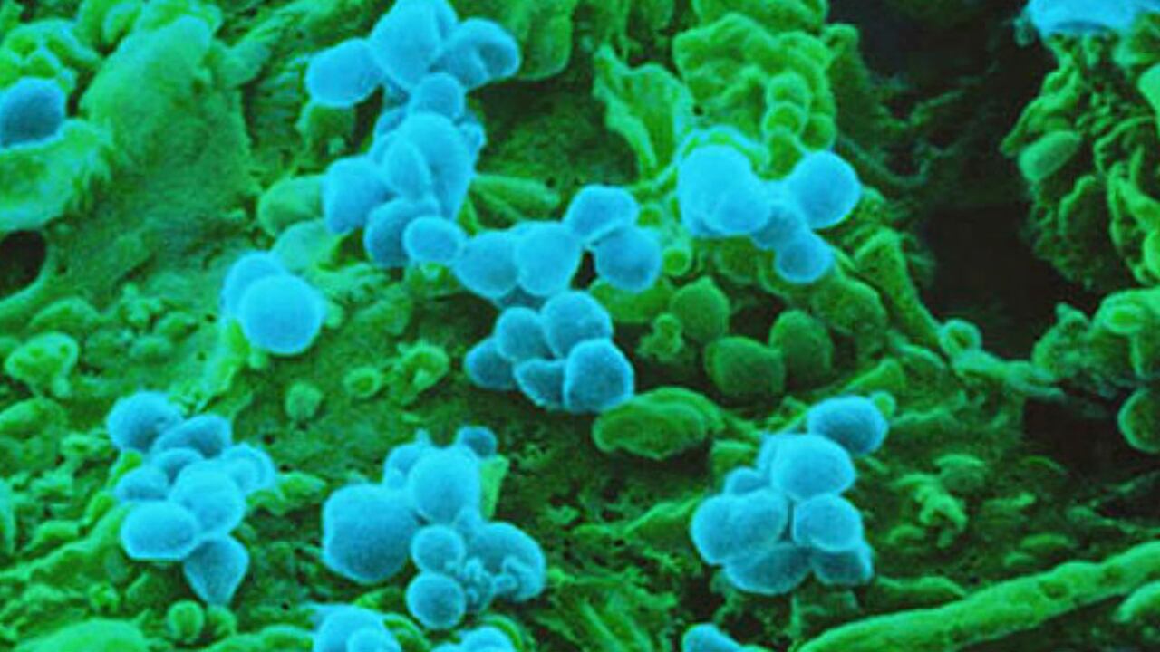 Virus del sarampión (azul) sobre una célula infectada (verde).