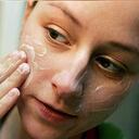 El aumento hormonal durante la adolescencia puede ser una de las causas del acné.