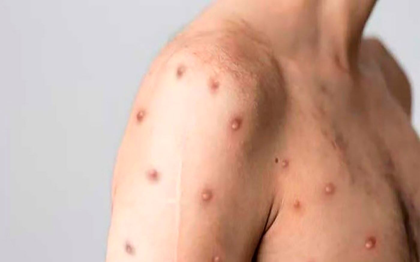 En Colombia se han detectado 4.085 casos de MPox.