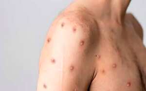 En Colombia se han detectado 4.085 casos de MPox.