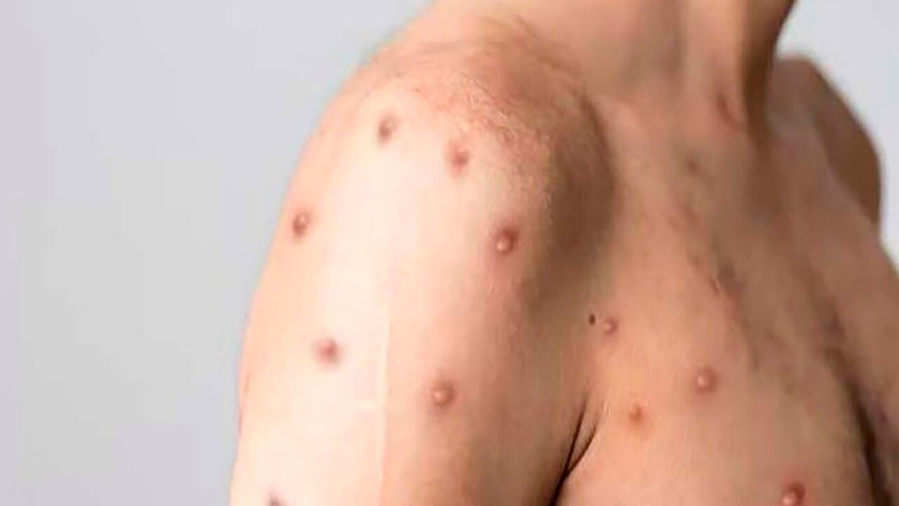 En Colombia se han detectado 4.085 casos de MPox.