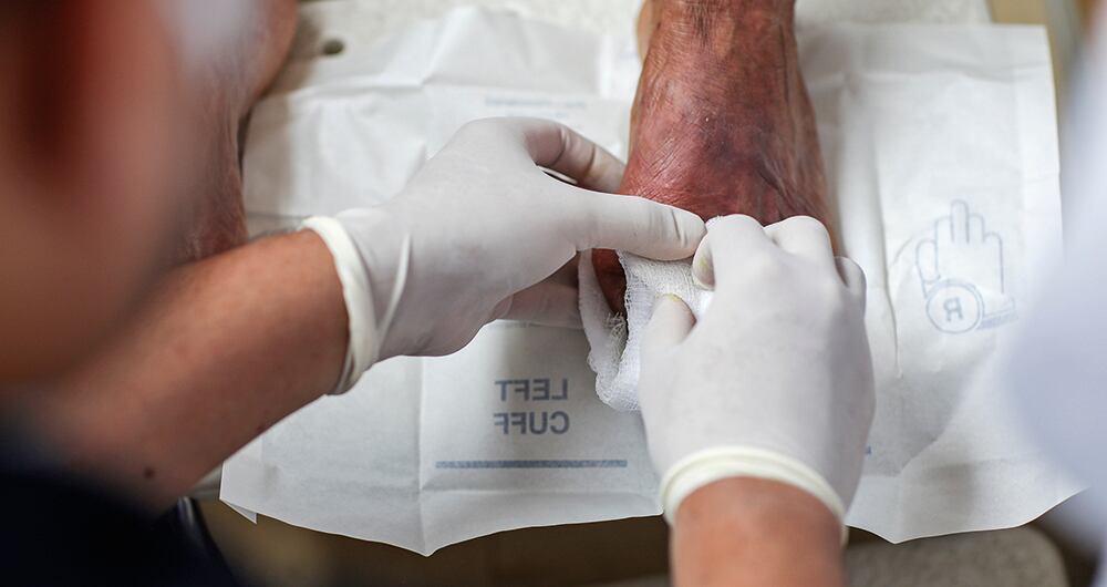 El pie diabético se da como consecuencia de los niveles altos de azúcar en sangre que dañan, poco a poco y para siempre los nervios y vasos sanguíneos de los pies.