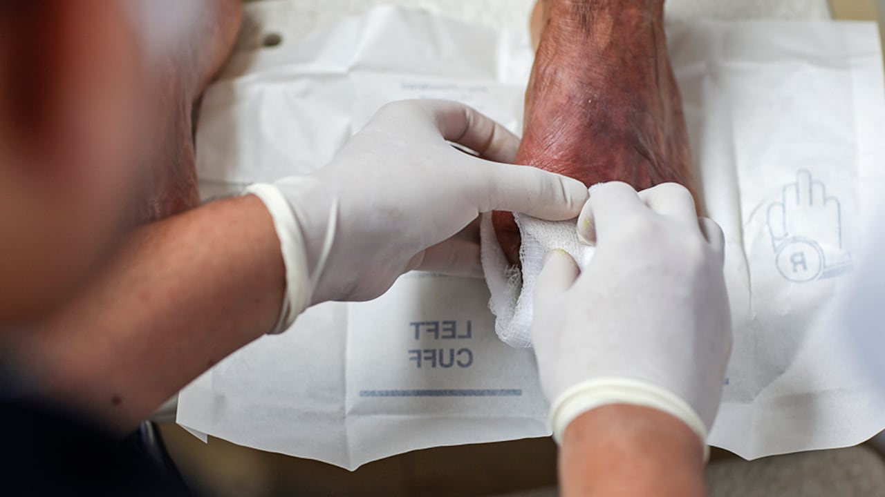 El pie diabético se da como consecuencia de los niveles altos de azúcar en sangre que dañan, poco a poco y para siempre los nervios y vasos sanguíneos de los pies.