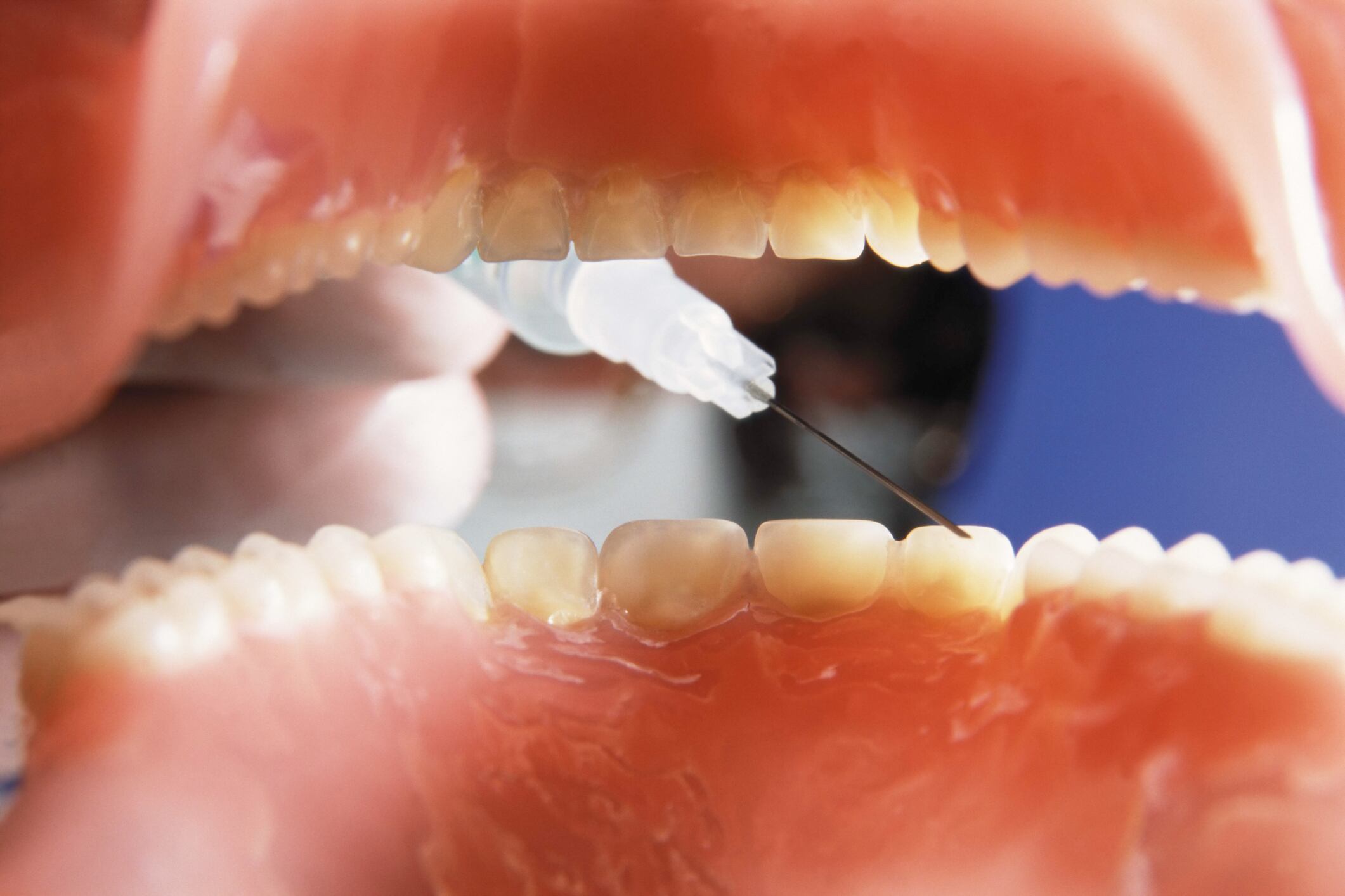 Dentadura - Imagen de referencia