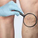 venas hinchadas y retorcidas que pueden verse bajo la piel y suelen aparecer en las piernas.