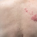 Herpes zóster, culebrilla, varicela zóster, piel