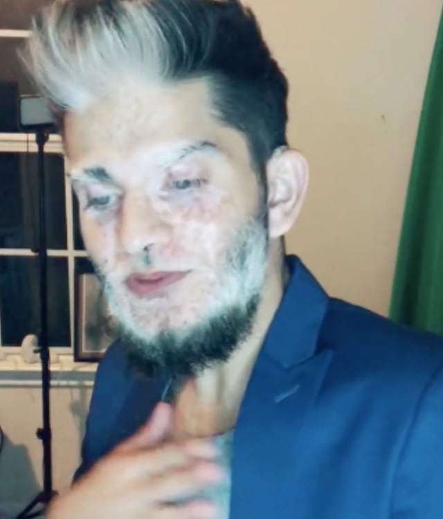 Su pelo blanco y sus despigmentación hacen que luzca mayor