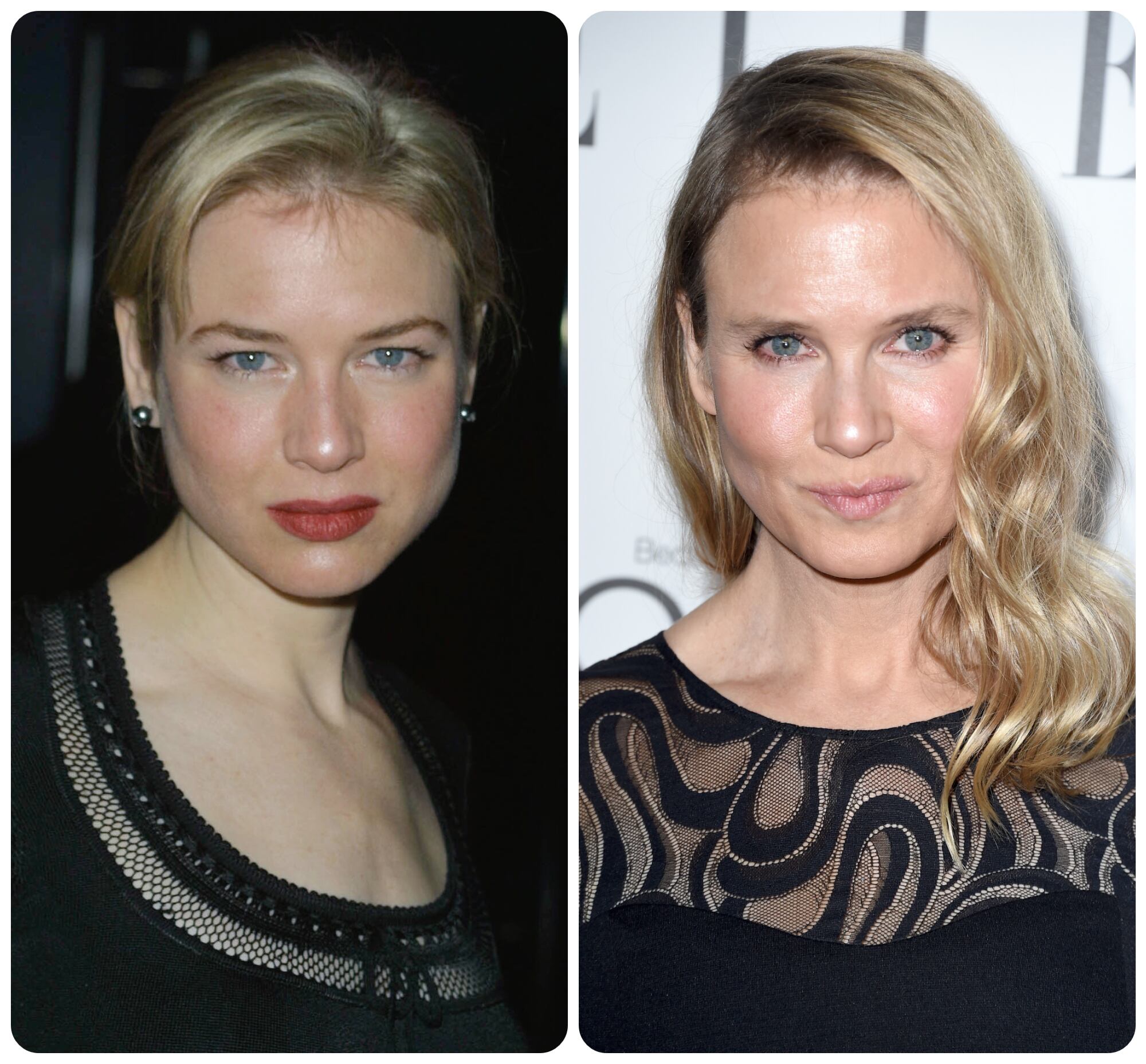 Los rellenos dérmicos cambiaron para siempre a la intérprete de Bridget Jones.