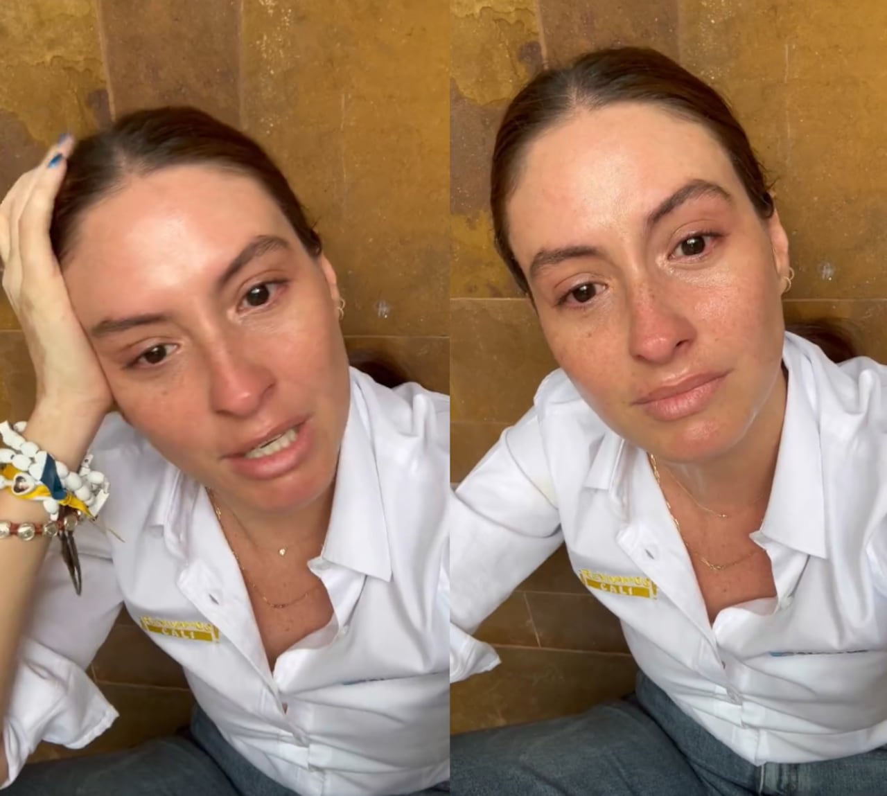 Taliana Vargas: ¿qué es el vitiligo y cuáles son los síntomas? - Semana