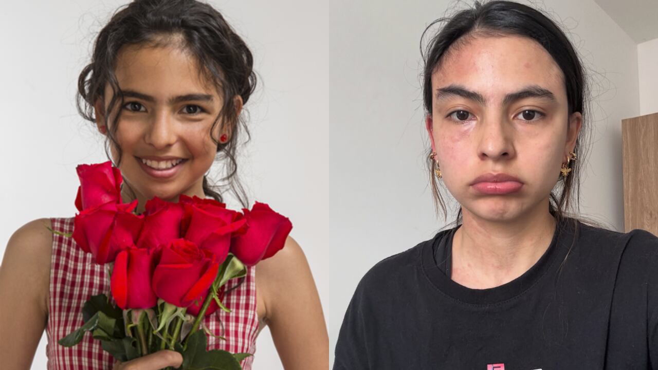 La joven actriz expuso fotografías y videos de su enfermedad en la piel.