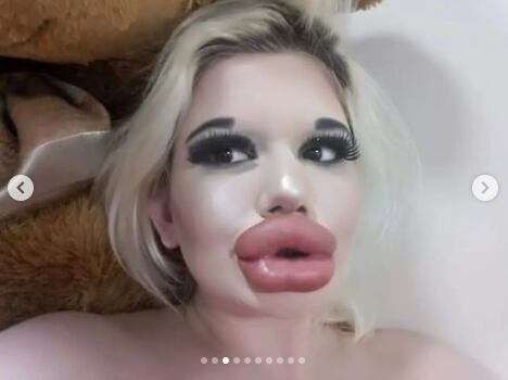 Para financiar sus procedimientos, Ivanova ha subastado besos a través de Instagram.