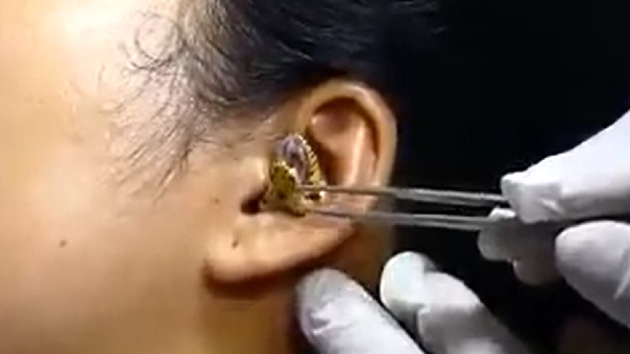 Impresionante video muestra intervención para extraer serpiente de oído de una mujer. El caso genera tanta impresión que algunas personas han señalado que podría ser falso.