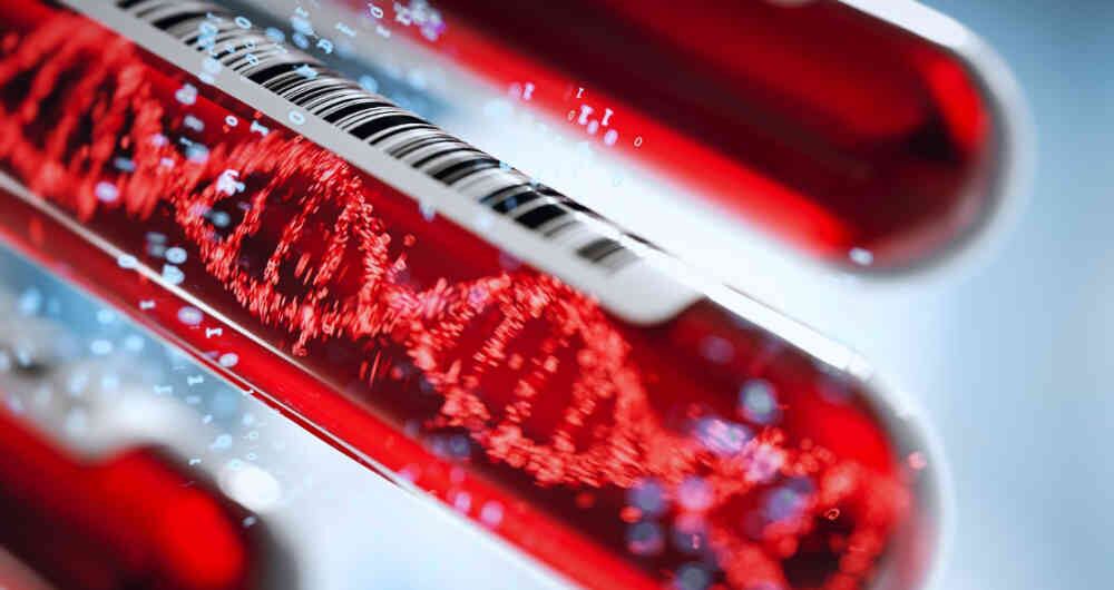 El riesgo de ictus o accidente cerebrovascular (ACV) temprano puede estar relacionado con las variantes genéticas asociadas con el grupo sanguíneo de una persona.