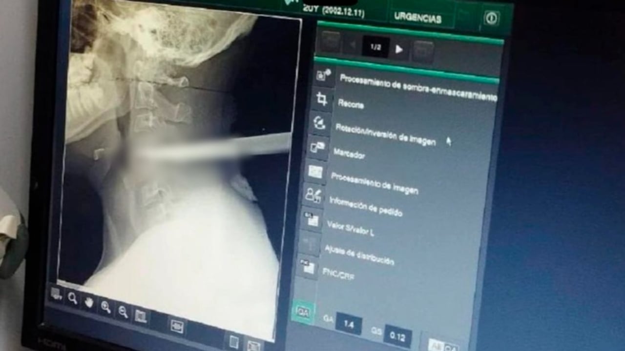 El joven tuvo esta arma cortopunzante en su cuello, por varias horas.