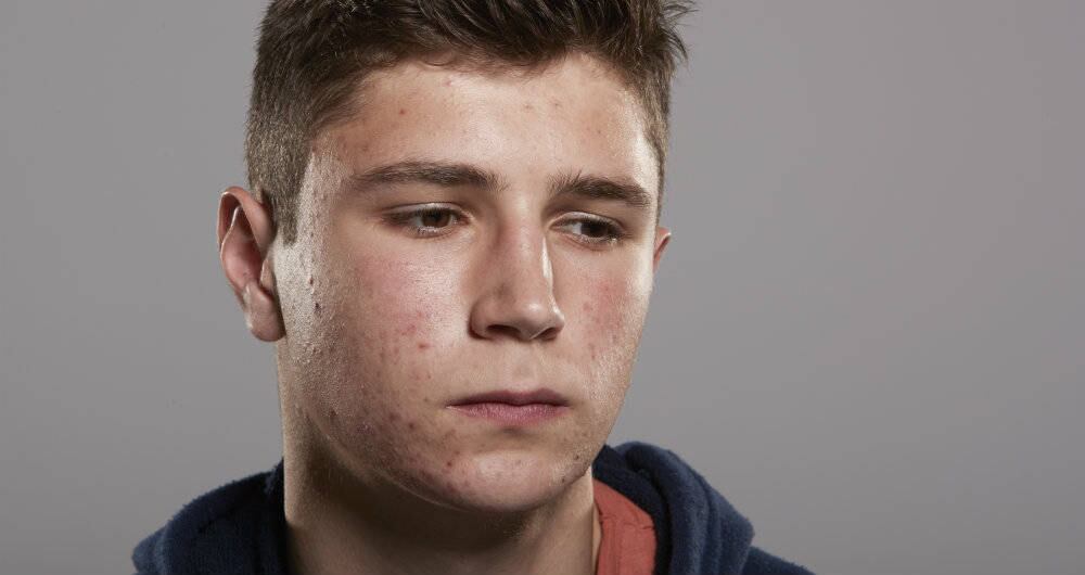 En temas de piel, la consulta más frecuente es el acné.