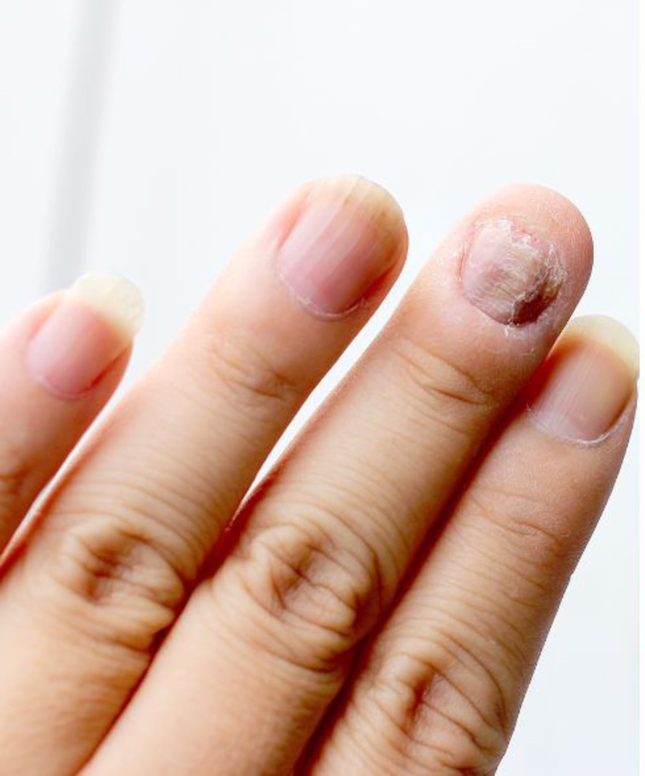 El remedio definitivo para eliminar los hongos en las uñas de las manos.