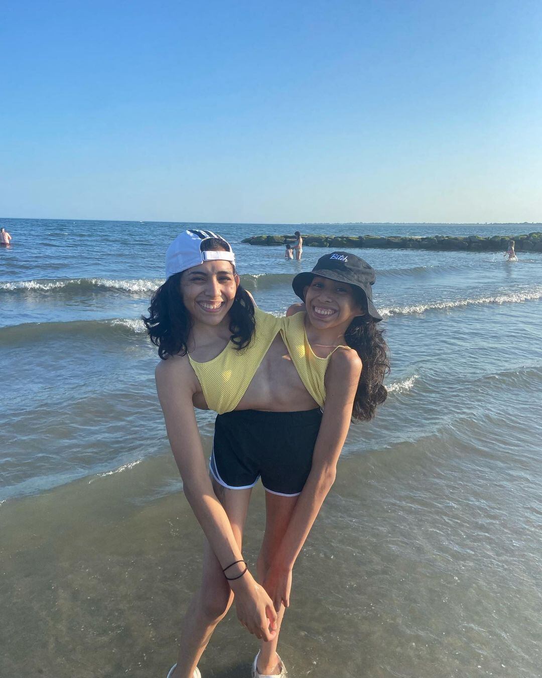 Las hermanas siamesas intentaron someterse a una cirugía de separación, pero finalmente no lo lograron debido a los altos riesgos que conlleva.