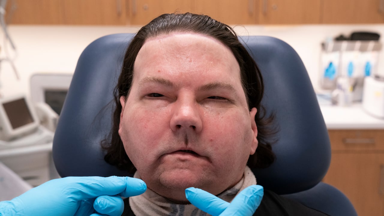 Joe DiMeo fue el primer hombre en recibir un trasplante de cara y manos