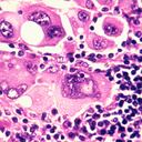 El cáncer metastásico acaba con muchas vidas en el mundo.