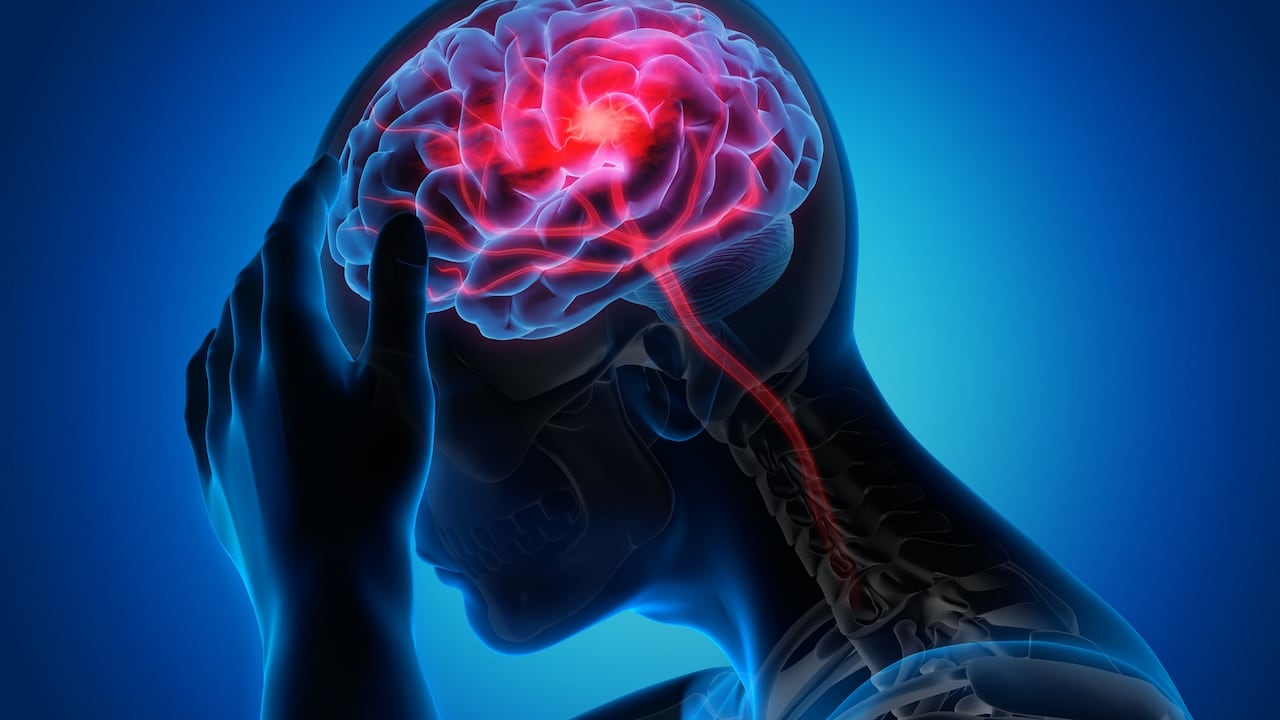 Los accidentes cerebrovasculares son una causa importante de muerte en el mundo.