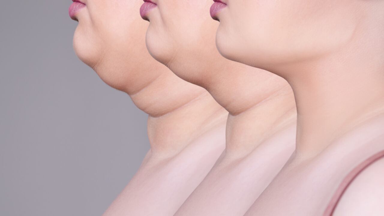 La papada hace que el contorno oval se desdibuje convirtiéndose en un tema estético que puede aumentar con la vejez.