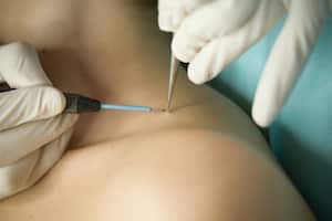 Las verrugas pueden aparecer en cualquier parte del cuerpo, pero una de las zonas en donde más se evidencian es en el cuello.