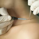 Las verrugas pueden aparecer en cualquier parte del cuerpo, pero una de las zonas en donde más se evidencian es en el cuello.