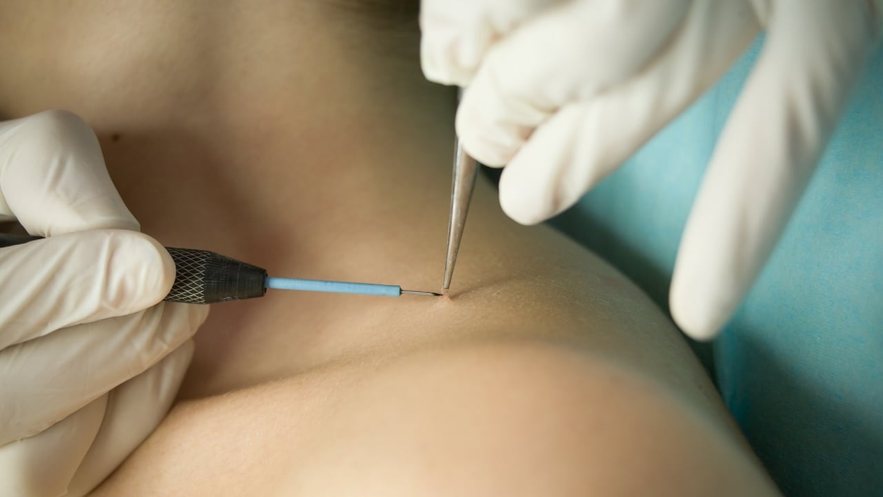 Las verrugas pueden aparecer en cualquier parte del cuerpo, pero una de las zonas en donde más se evidencian es en el cuello.