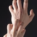 La dermatitis de contacto en sus dos formas: irritativa, la más común en adultos, producida por una sustancia.