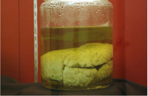 Un especímen que sin duda atrae la atención es el cerebro que perteneció al asesino en serie John Rulloff. Fue un brillante filólogo a quien se le adjudican cinco asesinatos, entre ellos el de su hija y esposa. Rulloff fue condenado a muerte en 1870 y su ahorcamiento fue la última ejecución pública que se hizo en Nueva York. Su cerebro es uno de los más grandes registrados. 