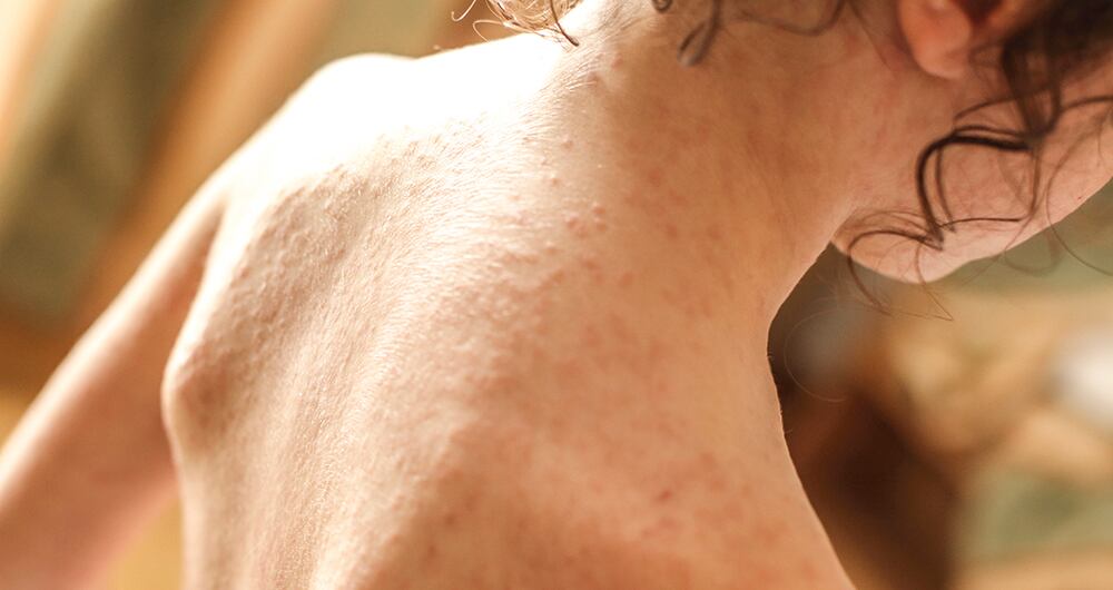 9.026 casos de viruela del mono se registran en Brasil, convirtiéndose en el país con más contagios en América Latina.