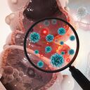 Este es uno de los cánceres más comunes en todo el mundo.