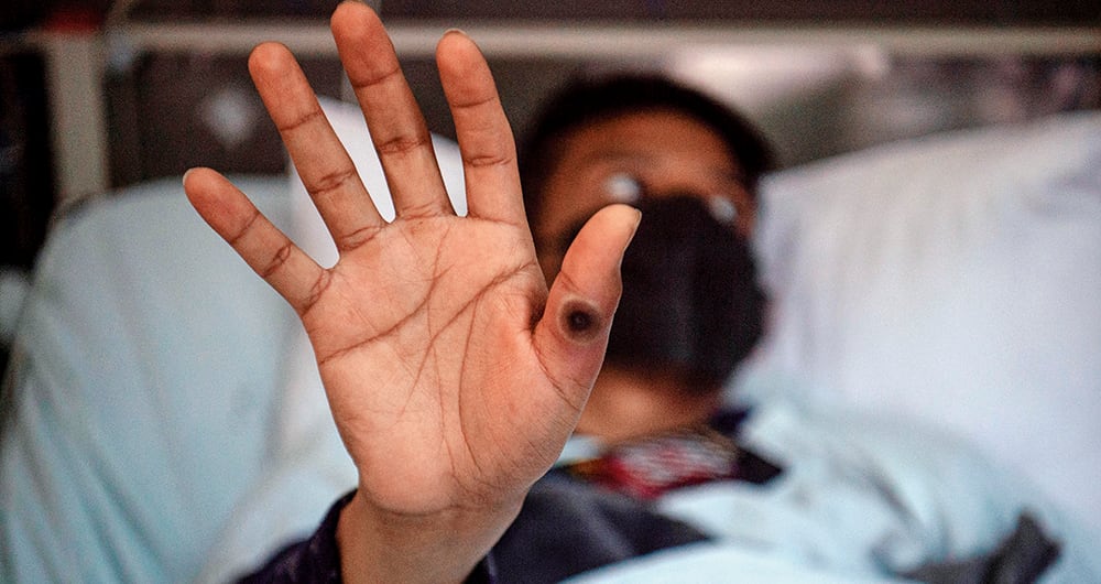 Por segunda vez, en menos de dos años, la OMS declaró la altamente infecciosa la mpox.
