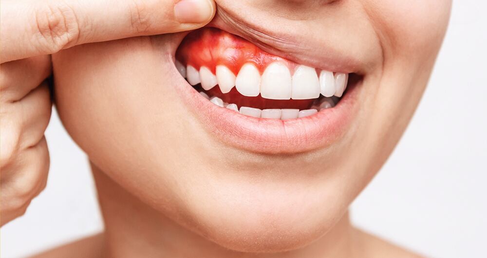 La evidencia científica muestra que los pacientes con periodontitis avanzada poseen riesgo elevado de padecer otras enfermedades sistémicas importantes, como infarto agudo de miocardio, diabetes y neumonía aspirativa. 