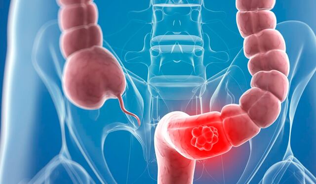 El diagnóstico temprano del cáncer de colon y recto abre la posibilidad de tener más opciones de tratamiento, con un mejor pronóstico y una recuperación más rápida. Reconocer síntomas y hacer los exámenes preventivos, podría salvar vidas.