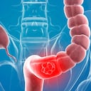 El diagnóstico temprano del cáncer de colon y recto abre la posibilidad de tener más opciones de tratamiento, con un mejor pronóstico y una recuperación más rápida. Reconocer síntomas y hacer los exámenes preventivos, podría salvar vidas.